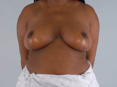 Real patient Breast Reduction by Dr.Pittman, Washington D.C.