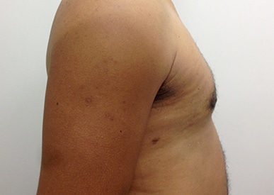 Real patient Gynecomastia by Dr.Pittman, Washington D.C.