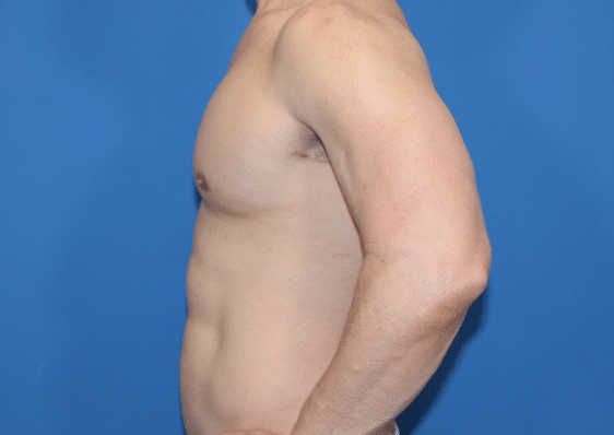 Real patient Pectoral Augmentation by Dr.Pittman, Washington D.C.
