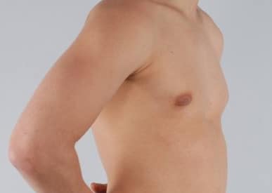 Real patient Gynecomastia by Dr.Pittman, Washington D.C.
