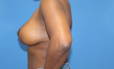 Real patient Breast Reduction by Dr.Pittman, Washington D.C.