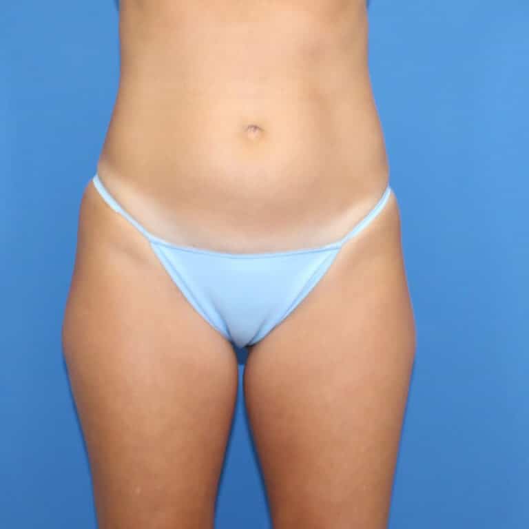 Real patient Liposuction by Dr.Pittman, Washington D.C.