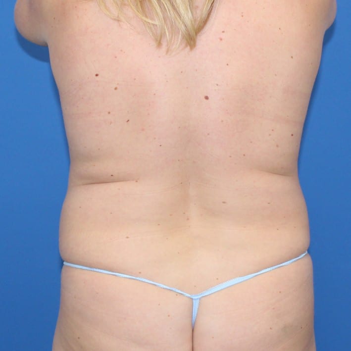 Real patient Liposuction by Dr.Pittman, Washington D.C.