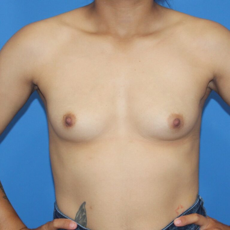 Real patient Breast Augmentation by Dr.Pittman, Washington D.C.