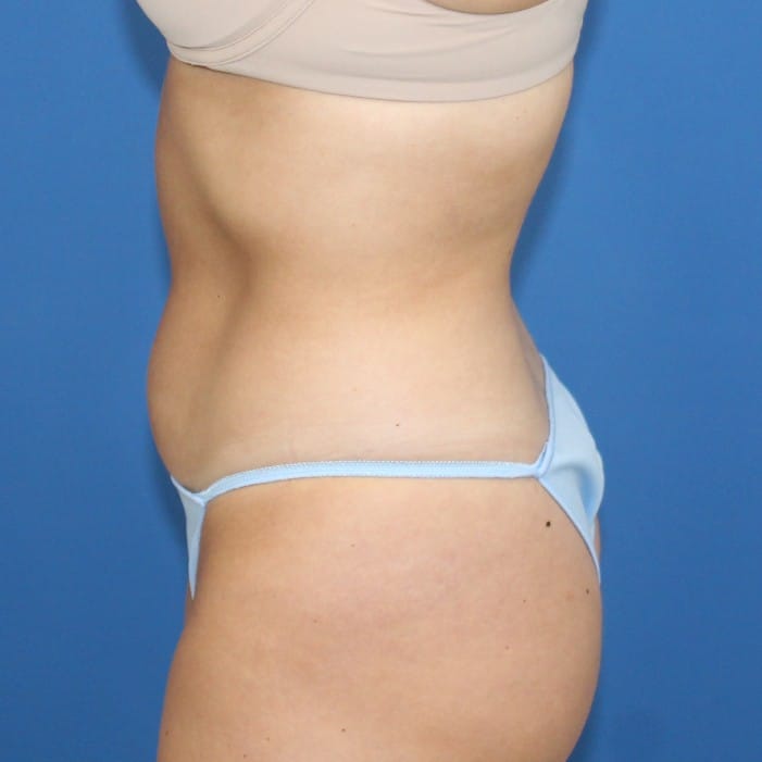 Real patient Liposuction by Dr.Pittman, Washington D.C.