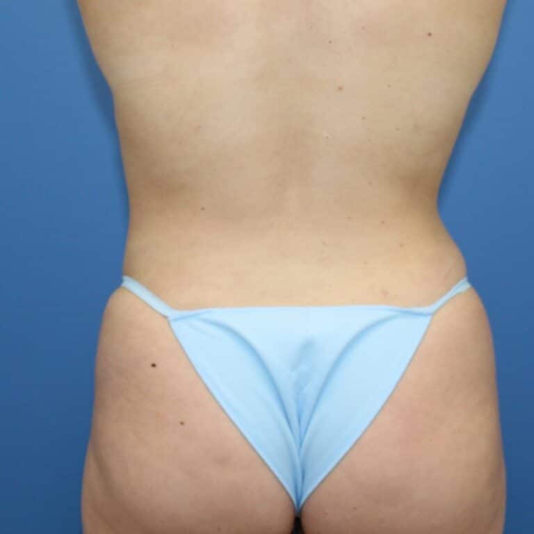 Real patient Liposuction by Dr.Pittman, Washington D.C.