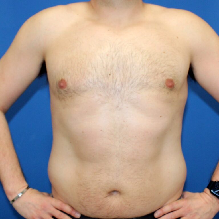 Real patient Gynecomastia by Dr.Pittman, Washington D.C.