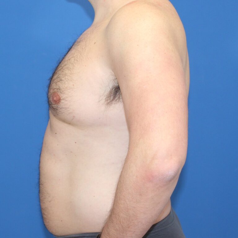 Real patient Gynecomastia by Dr.Pittman, Washington D.C.