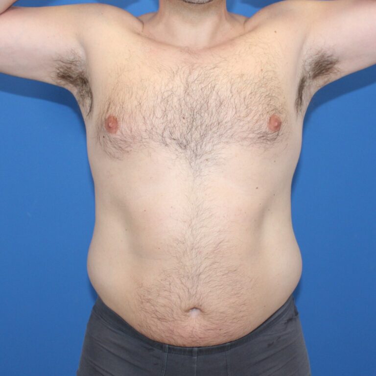 Real patient Liposuction by Dr.Pittman, Washington D.C.