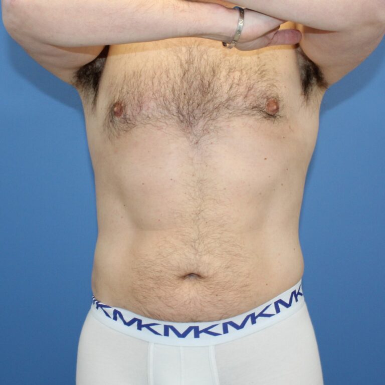 Real patient Liposuction by Dr.Pittman, Washington D.C.