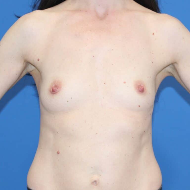 Real patient Breast Augmentation by Dr.Pittman, Washington D.C.