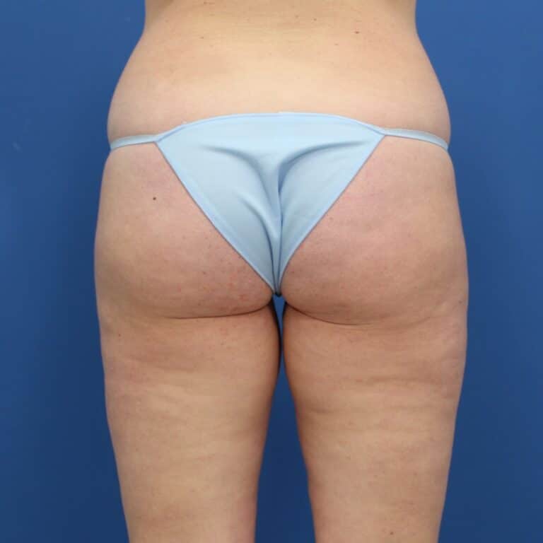 Real patient Liposuction by Dr.Pittman, Washington D.C.