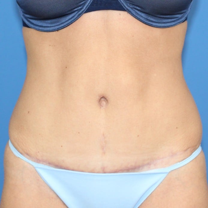 Real patient Abdominoplasty by Dr.Pittman, Washington D.C.