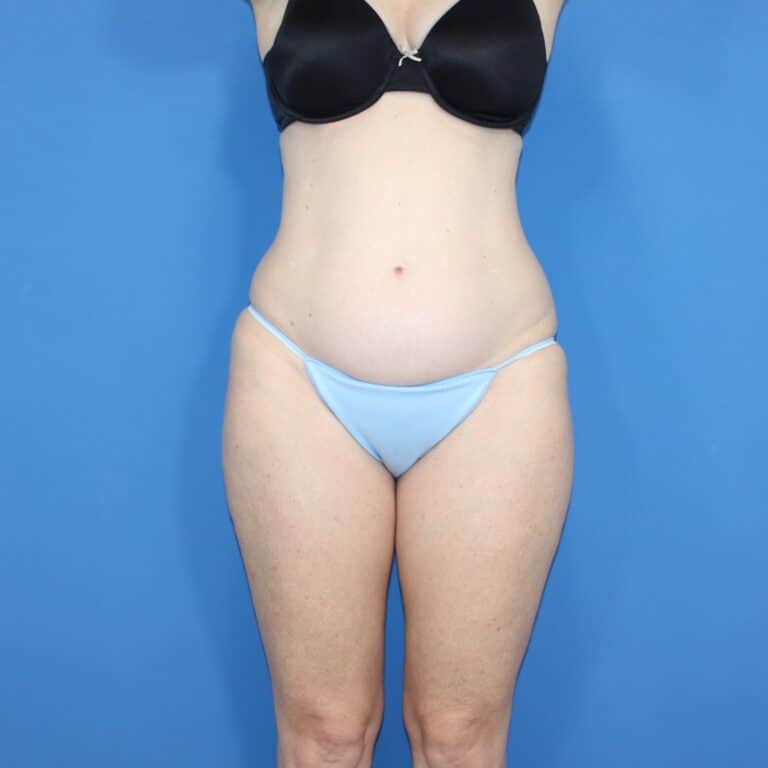 Real patient Liposuction by Dr.Pittman, Washington D.C.