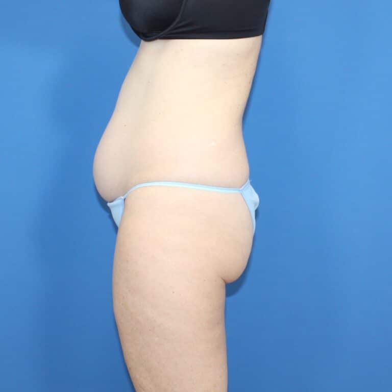 Real patient Liposuction by Dr.Pittman, Washington D.C.