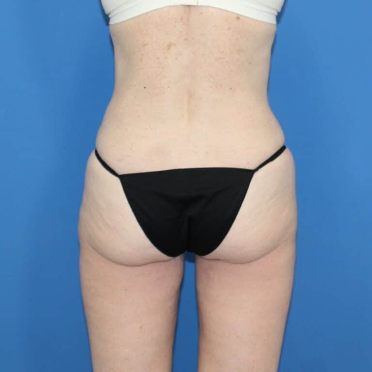Real patient Liposuction by Dr.Pittman, Washington D.C.