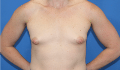 Real patient Breast Augmentation by Dr.Pittman, Washington D.C.