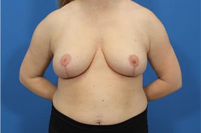 Real patient Breast Reduction by Dr.Pittman, Washington D.C.