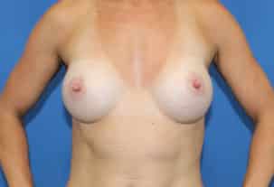 Real patient Breast Augmentation by Dr.Pittman, Washington D.C.