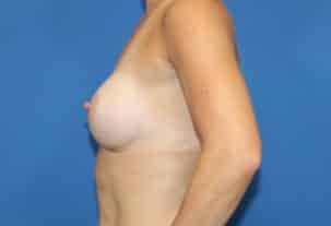Real patient Breast Augmentation by Dr.Pittman, Washington D.C.