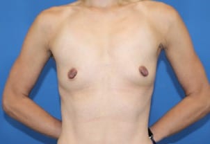 Real patient Breast Augmentation by Dr.Pittman, Washington D.C.