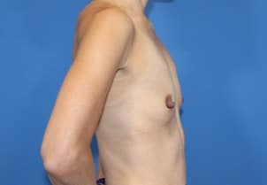 Real patient Breast Augmentation by Dr.Pittman, Washington D.C.