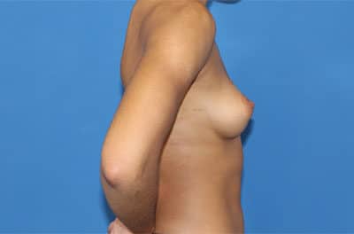 Real patient Breast Augmentation by Dr.Pittman, Washington D.C.