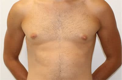 Real patient Gynecomastia by Dr.Pittman, Washington D.C.