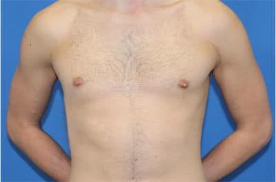 Real patient Gynecomastia by Dr.Pittman, Washington D.C.