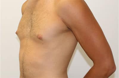 Real patient Gynecomastia by Dr.Pittman, Washington D.C.