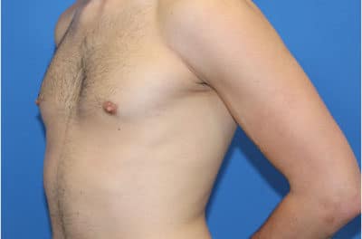 Real patient Gynecomastia by Dr.Pittman, Washington D.C.