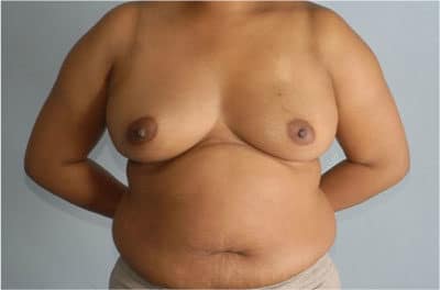 Real patient Abdominoplasty by Dr.Pittman, Washington D.C.