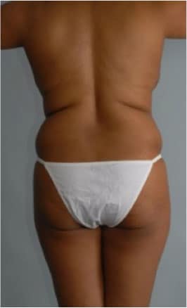 Real patient Abdominoplasty by Dr.Pittman, Washington D.C.