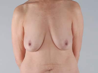 Real patient Mastopexy Breast Lift by Dr.Pittman, Washington D.C.