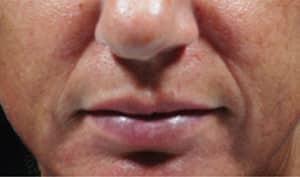 Real patient Bellafill, Somenek + Pittman MD, Washington D.C.