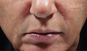 Real patient Bellafill, Somenek + Pittman MD, Washington D.C.