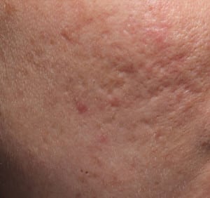 Real patient Acne Scar Treament, Somenek + Pittman MD, Washington D.C.