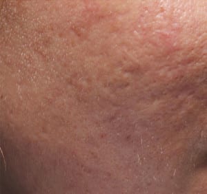 Real patient Acne Scar Treament, Somenek + Pittman MD, Washington D.C.