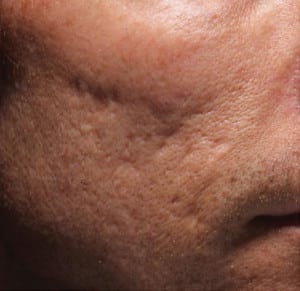 Real patient Acne Scar Treament, Somenek + Pittman MD, Washington D.C.