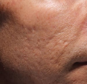 Real patient Acne Scar Treament, Somenek + Pittman MD, Washington D.C.
