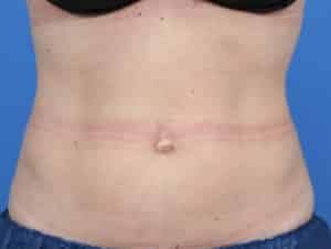 Real Patient truSculptFlex, Somenek + Pittman MD, Washington D.C.