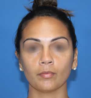 Real patient Rhinoplasty by Dr.Somenek, Washington D.C.