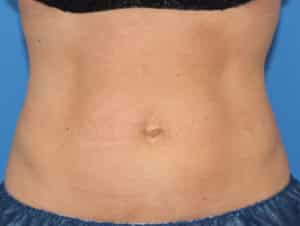 Real Patient truSculptFlex, Somenek + Pittman MD, Washington D.C.