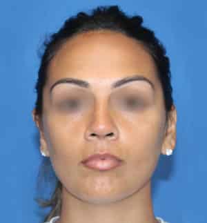 Real patient Rhinoplasty by Dr.Somenek, Washington D.C.