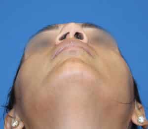 Real patient Rhinoplasty by Dr.Somenek, Washington D.C.