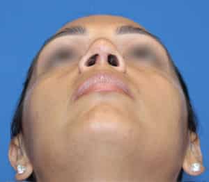 Real patient Rhinoplasty by Dr.Somenek, Washington D.C.