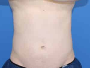 Real Patient truSculptFlex, Somenek + Pittman MD, Washington D.C.