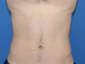 Real Patient truSculptFlex, Somenek + Pittman MD, Washington D.C.