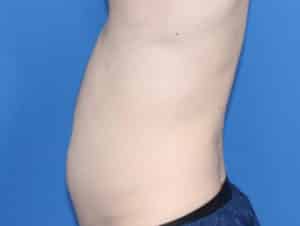 Real Patient truSculptFlex, Somenek + Pittman MD, Washington D.C.