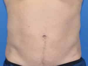 Real Patient truSculptFlex, Somenek + Pittman MD, Washington D.C.